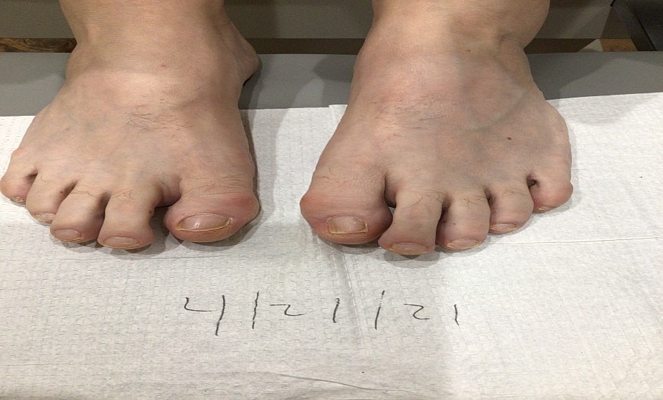 Fungal Laser Before & After