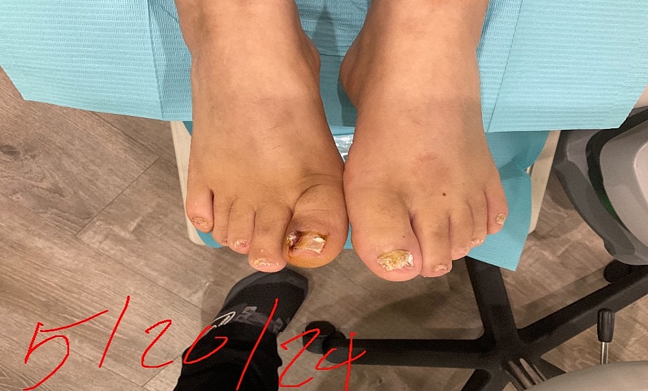 Fungal Laser Before & After