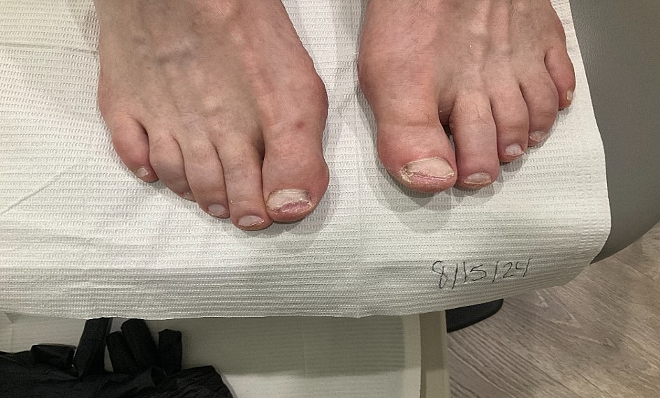 Fungal Laser Before & After