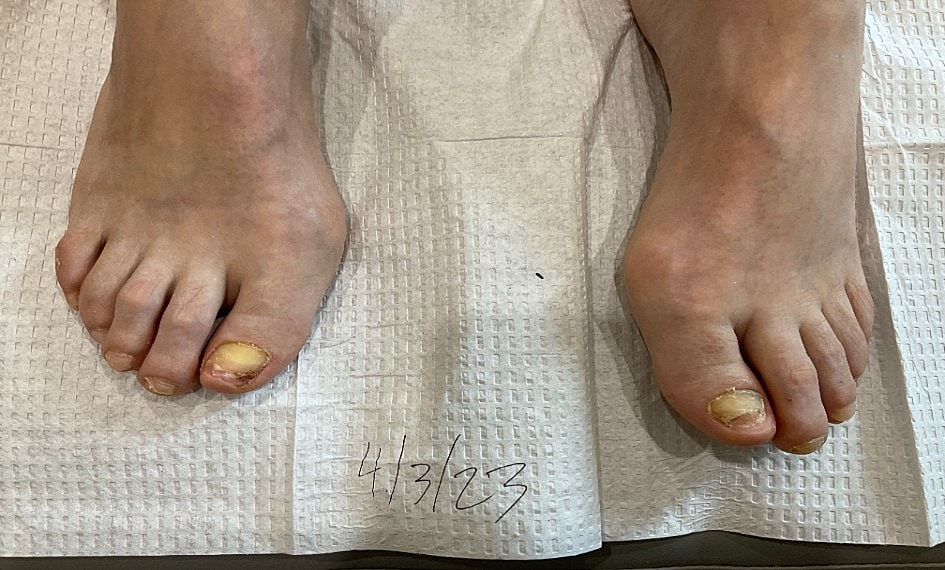 Fungal Laser Before & After