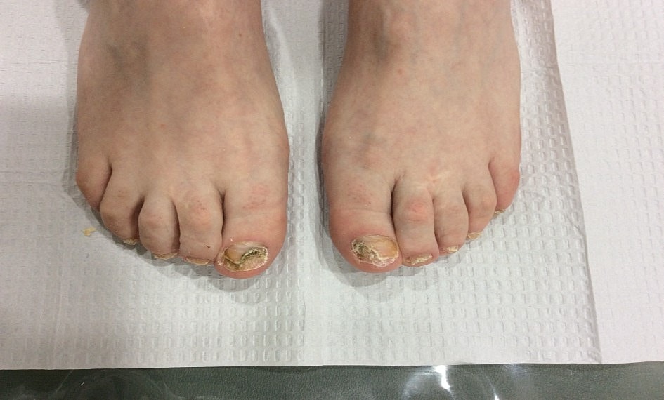 Fungal Laser Before & After