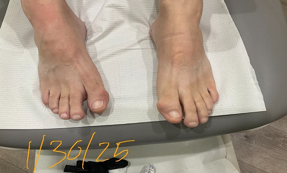 Fungal Laser Before & After