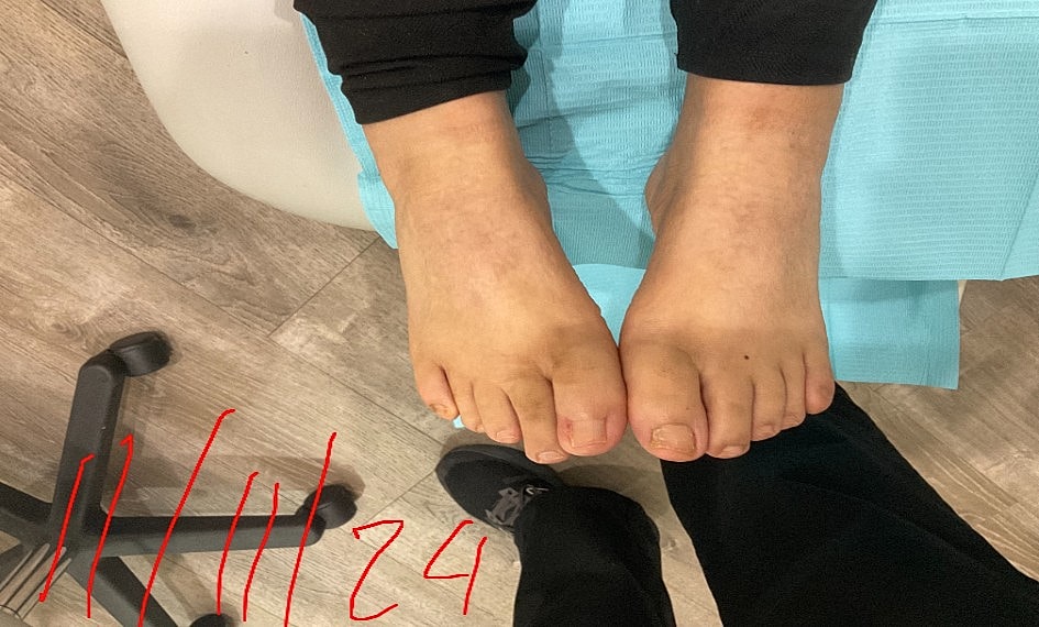 Fungal Laser Before & After