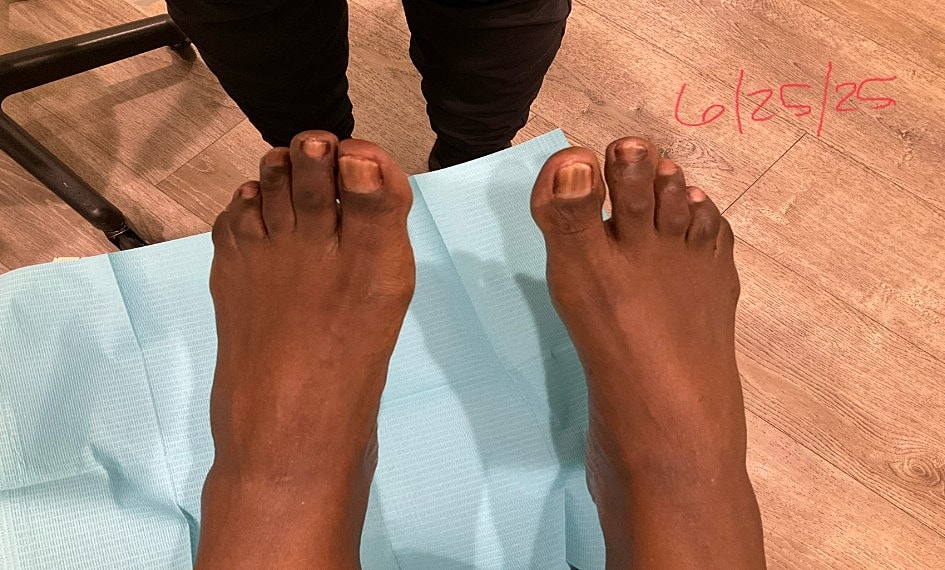 Fungal Laser Before & After