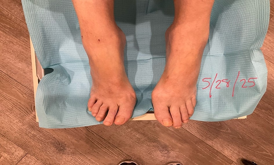 Fungal Laser Before & After