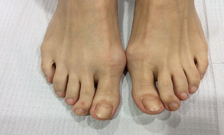 Fungal Laser Before & After