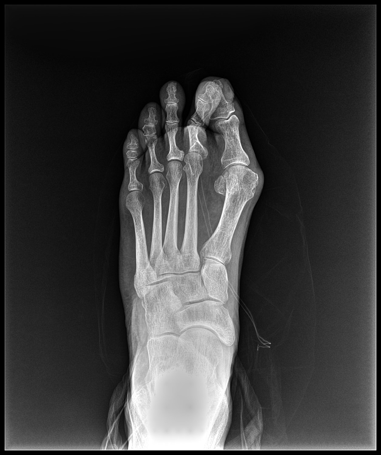 Arthrodesis Before & After