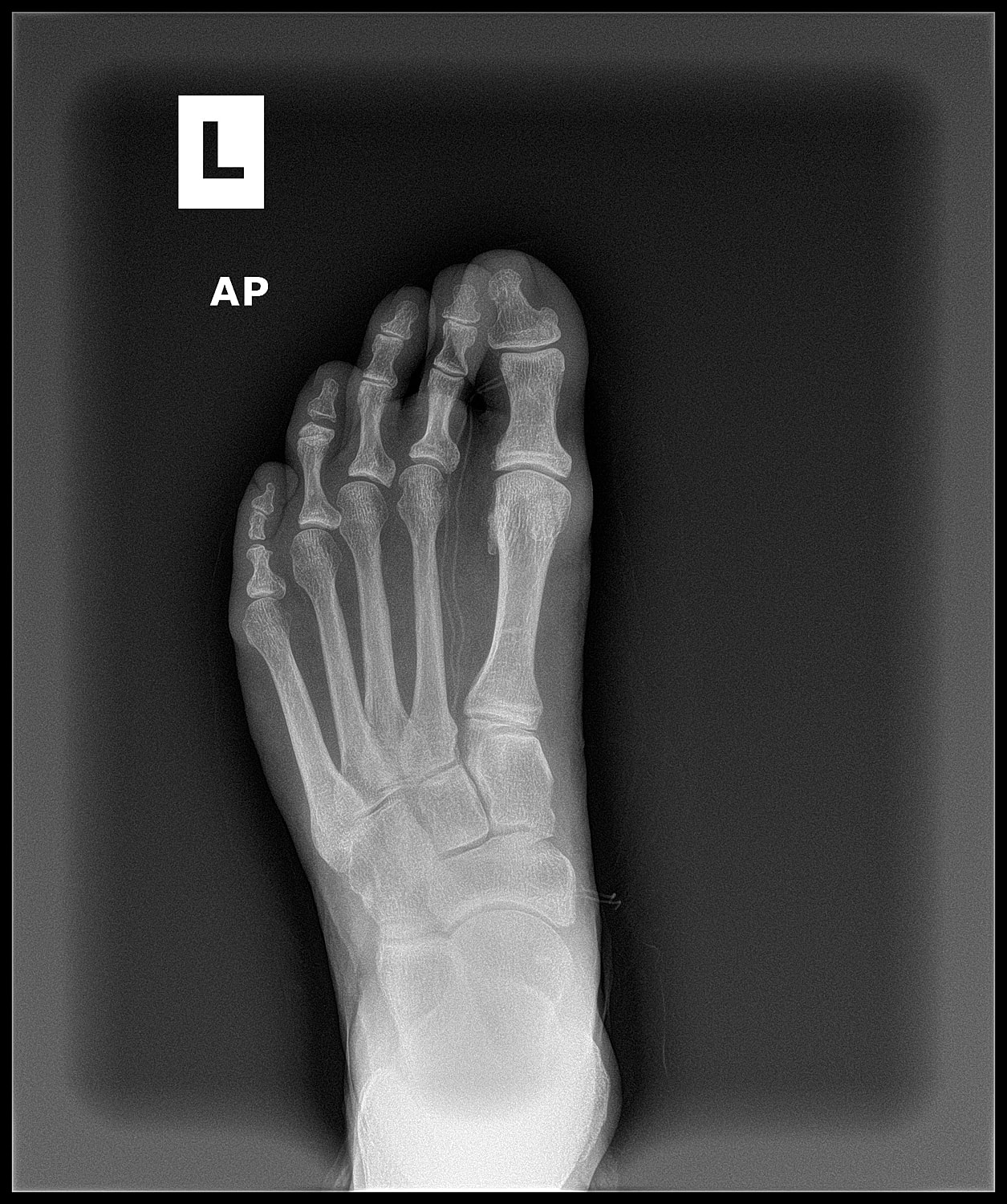 Arthrodesis Before & After