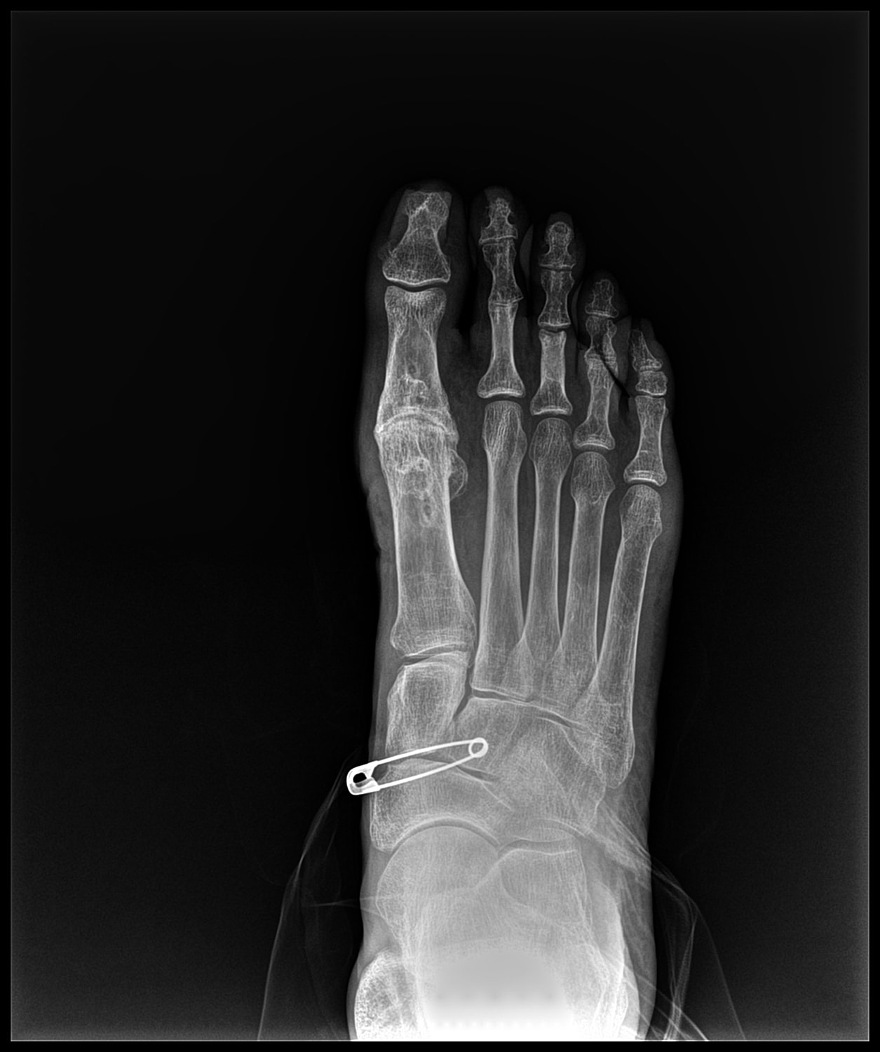 Arthrodesis Before & After