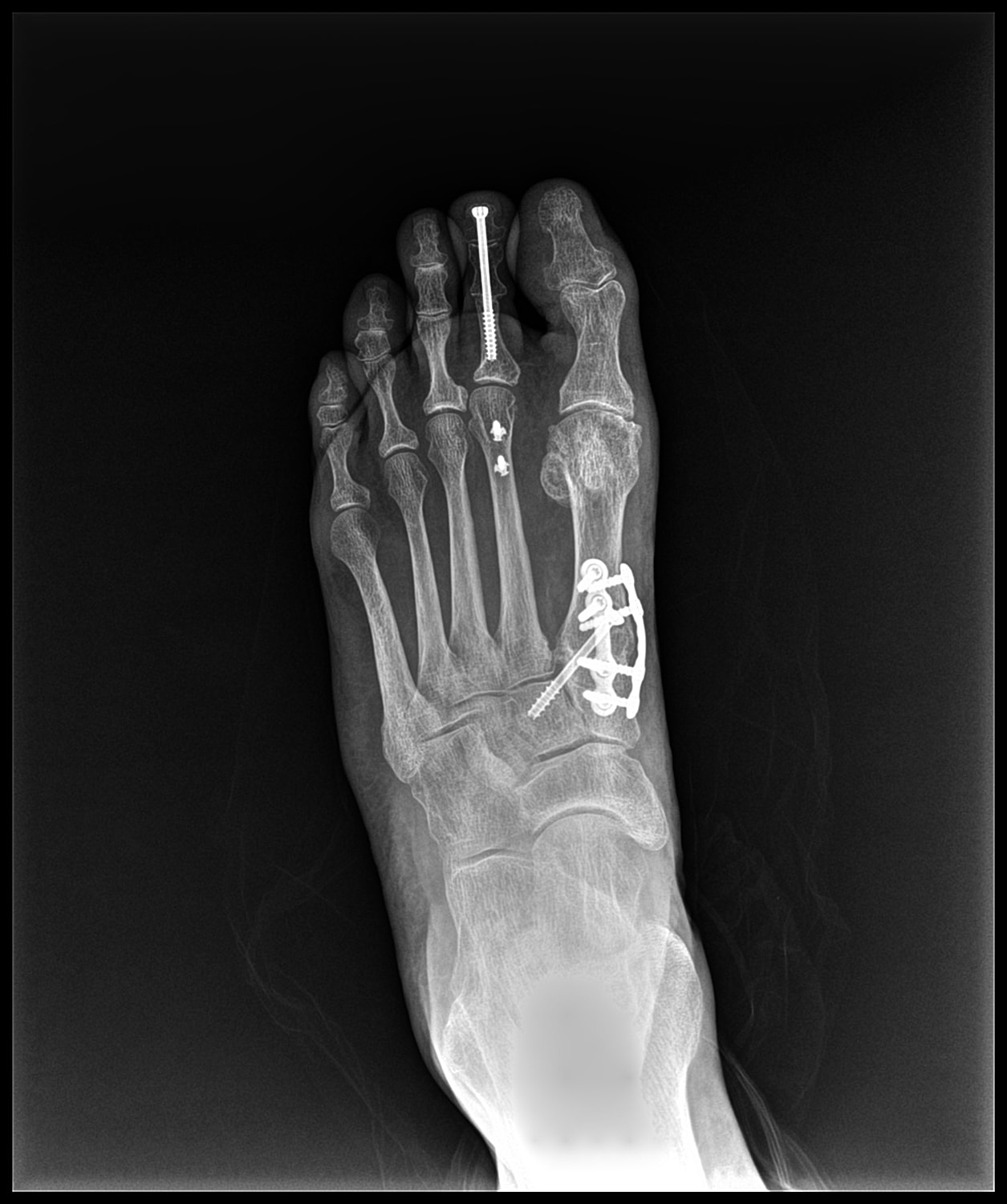 Arthrodesis Before & After