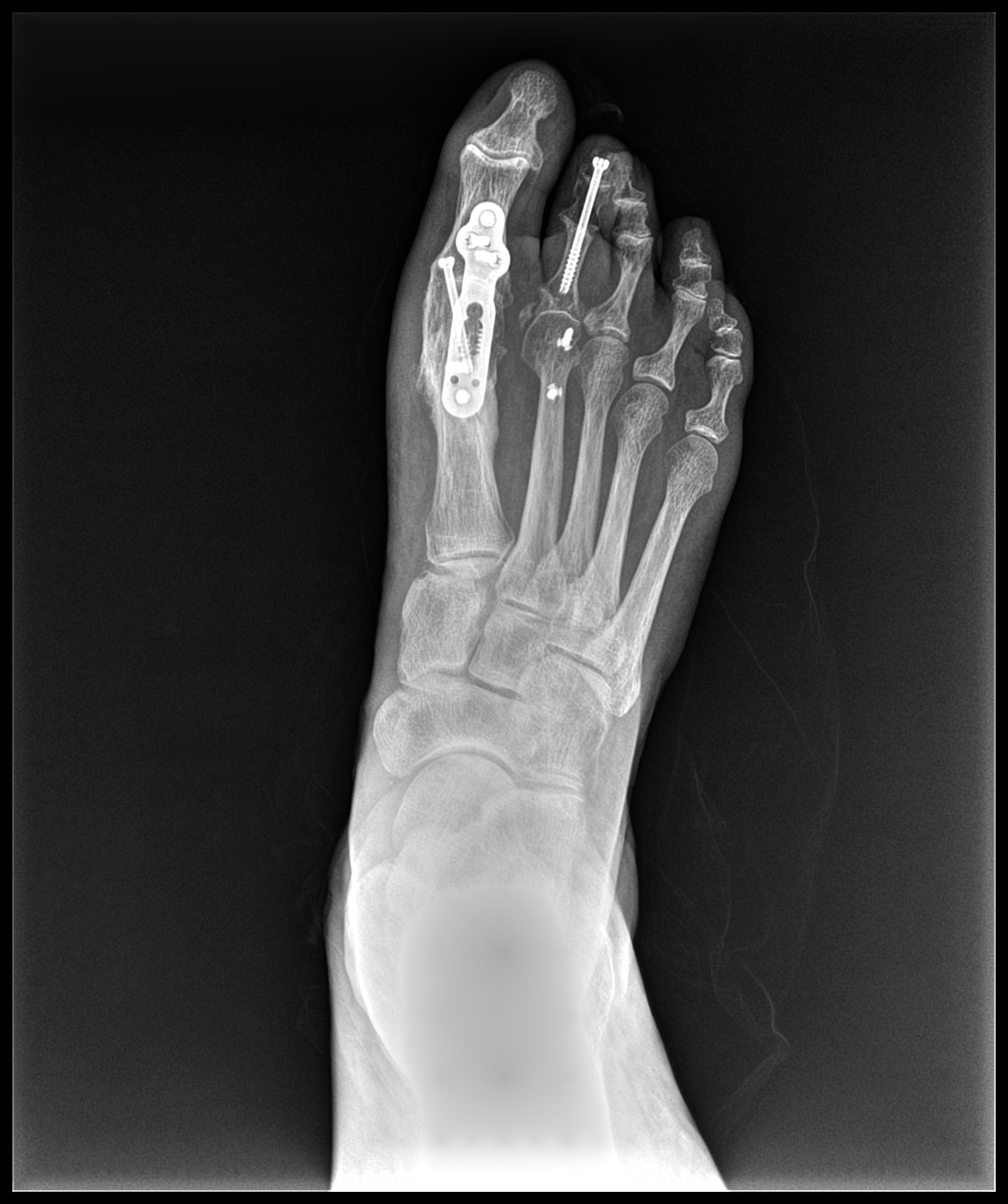 Arthrodesis Before & After
