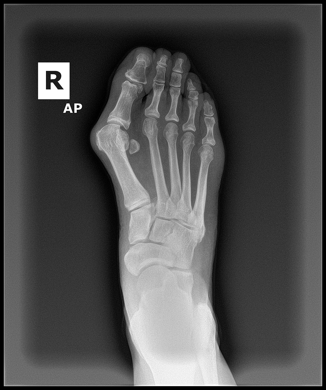 Aductoplasty Before & After