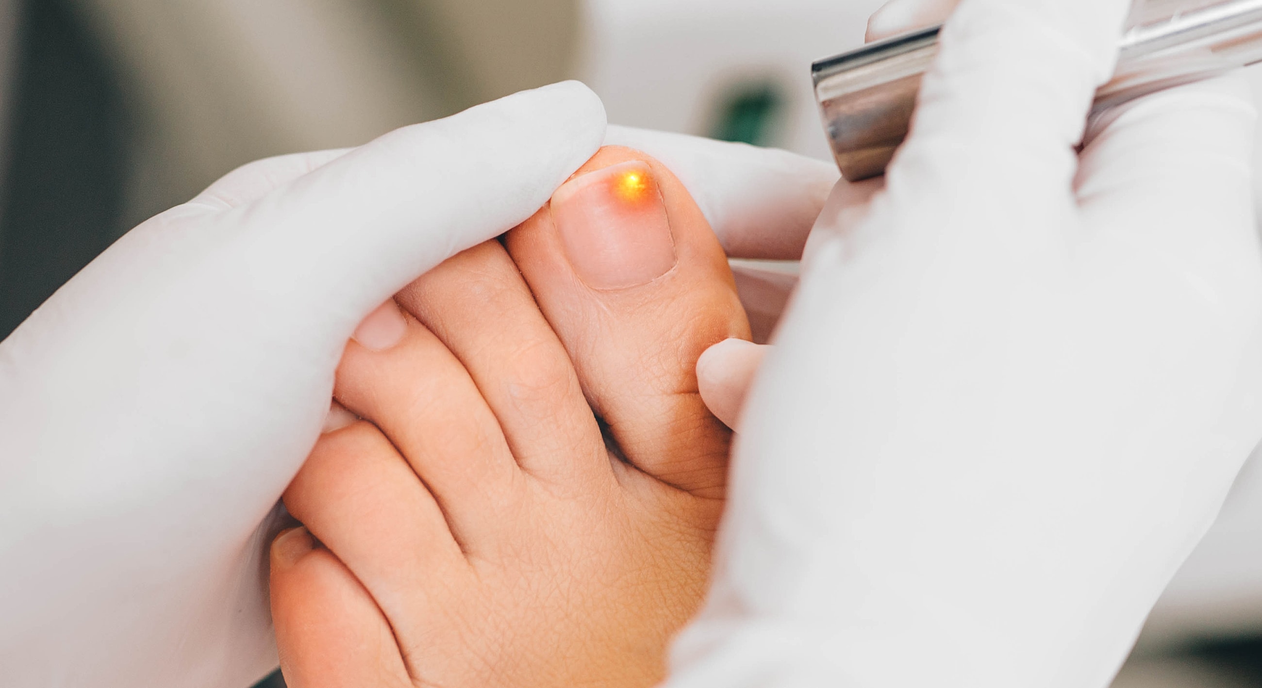 Laser treatment on toenail with gloved hands.